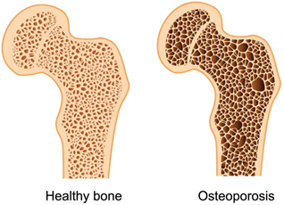BEING OVERWEIGHT IS HARMFUL FOR BONES AND KNEES